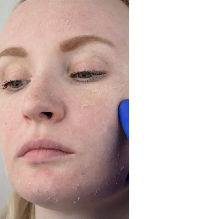 Antes: rostro con resequedad y descamación visible