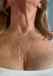 Before - 