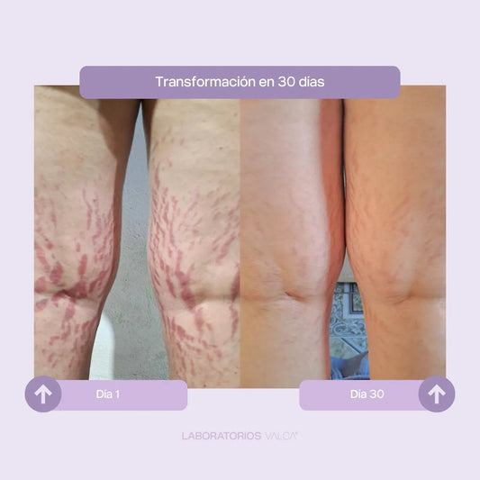 Valca Estrías® | Tratamiento estrias