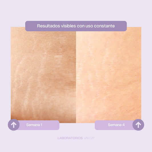 Valca Estrías® | Tratamiento estrias