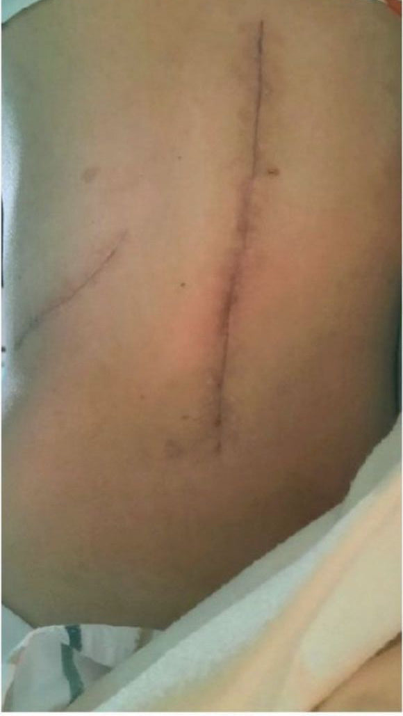 Antes